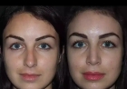 Septoplasty Cost in Dubai: What’s Included in the Price?