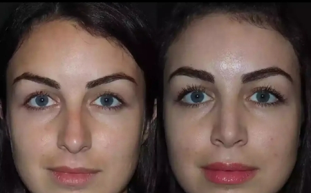 Nose Surgery in Dubai for Men: The Subtle Art of Refinement