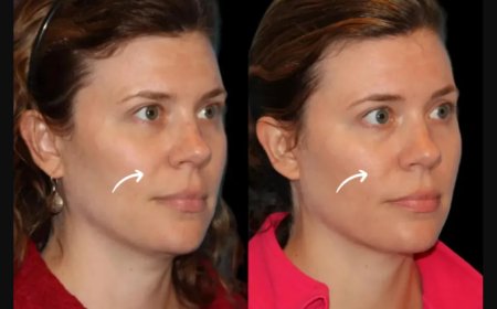 Transform Your Look with Sculptra Fillers in Dubai for Cheek Augmentation
