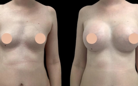 What Sets the Best Breast Augmentation Surgeon in Dubai Apart