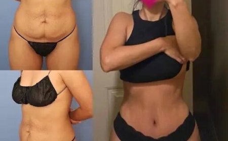 Expert Insights on Choosing the Best Tummy Tuck Surgeon in Dubai