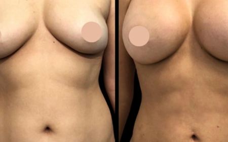 What Makes Breast Augmentation in Dubai So Popular?