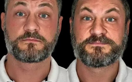 Spark Skin Revival with the Best Doctors in dubai and Profhilo