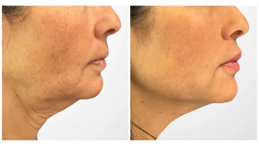 The Best Doctors in Dubai for Thread Lift: A Comprehensive Guide to Skin Tightening Treatments