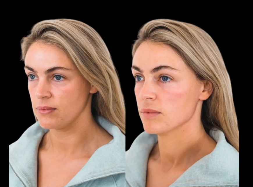 The Importance of Using the Right Product for Cheek Fillers with the Best Plastic Surgeon in Dubai