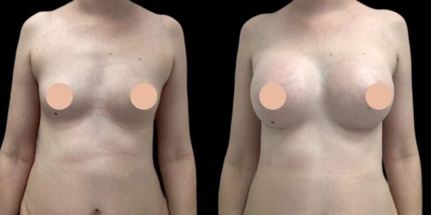 What Sets the Best Breast Augmentation Surgeon in Dubai Apart
