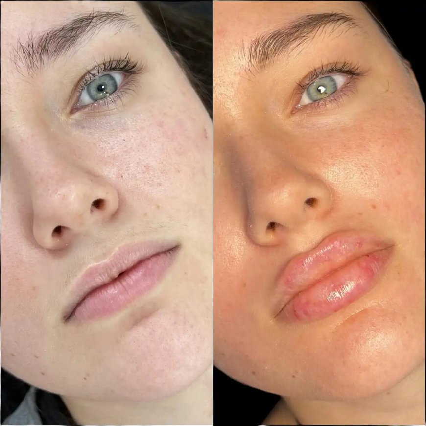 Choosing the Best Plastic Surgeon in Dubai for Dermal Fillers: Expert Tips