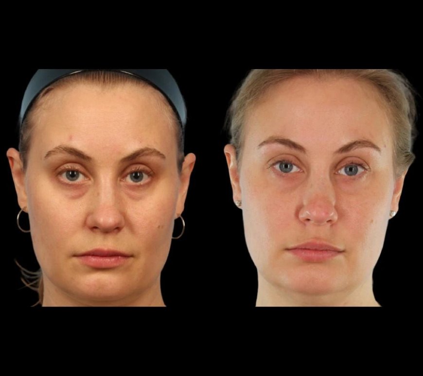 How the Best Plastic Surgeon in Dubai Ensures a Smooth Under Eye Fillers Experience