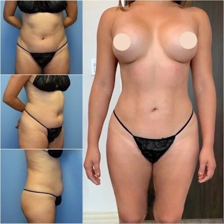 Choosing the Best Body Contouring Surgeon in Dubai for Stunning Results