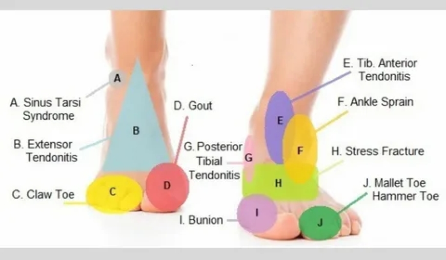 Importance Of Foot Pain Chart In Assessment Of Foot Pain