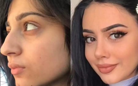 Non-Surgical Nose Surgery in Dubai: Is It Worth Considering?