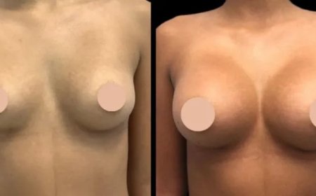 Breast Augmentation Surgery in Dubai: Why Choosing the Right Surgeon is Key to Success