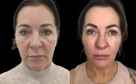 Before and After Profhilo: What the Best Plastic Surgeons in Dubai Recommend
