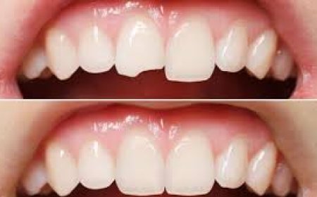 How Emergency Dentists Help Save Teeth After Accidents