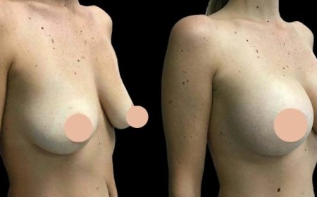 The Best Breast Augmentation Surgeons in Dubai: Key Factors in Achieving Long-Lasting Results