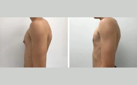 Understanding Gynecomastia Surgery in Dubai and Its Long-Term Benefits