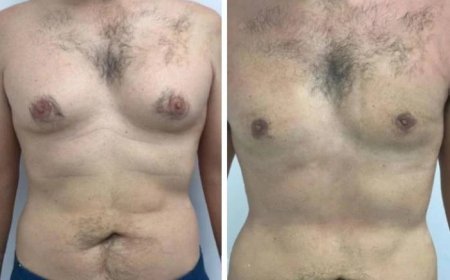 Common Misconceptions About Gynecomastia in Dubai Surgery