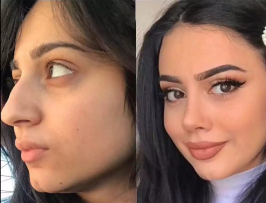 Non-Surgical Nose Surgery in Dubai: Is It Worth Considering?