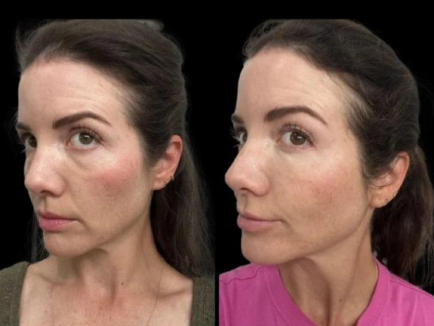 What to Expect During a Dark Circles trearmnet Consultation with the Best Plastic Surgeons in Dubai