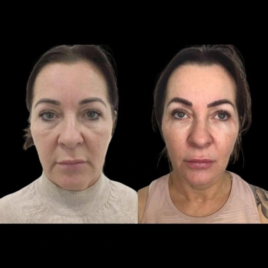 Before and After Profhilo: What the Best Plastic Surgeons in Dubai Recommend