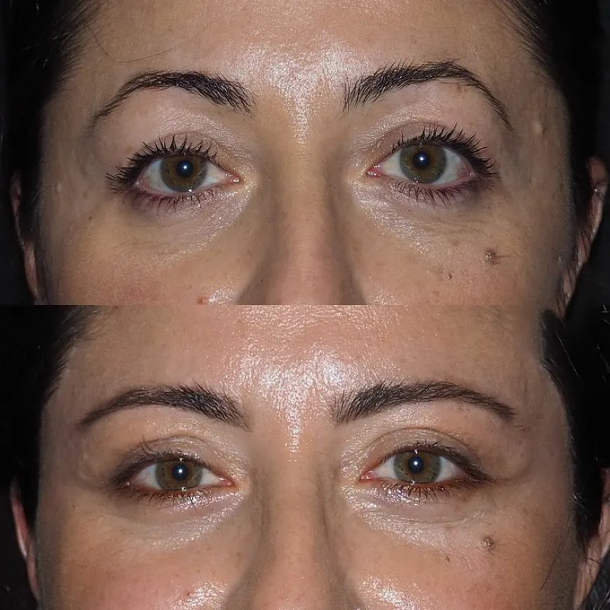 Is Eye Bag Removal Surgery in Dubai Right for You?