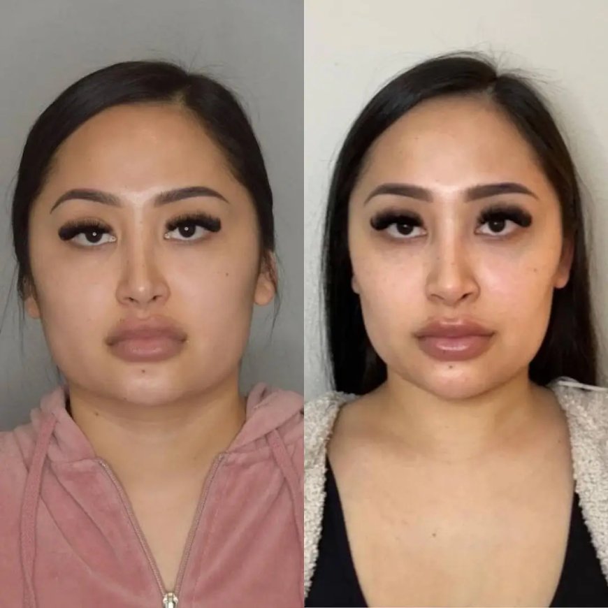 How Buccal fat removal Surgery in Dubai Helps Reduce Selfies’ Editing